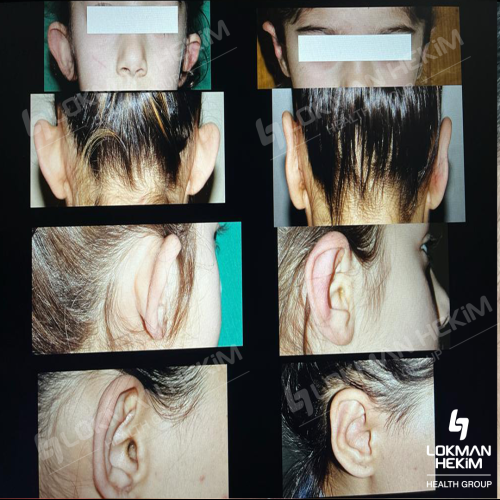 Chirurgie des oreilles décollées (Otoplastie) Photos avant & après